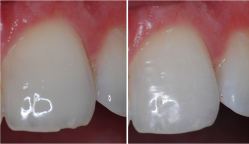 Composite Bonding