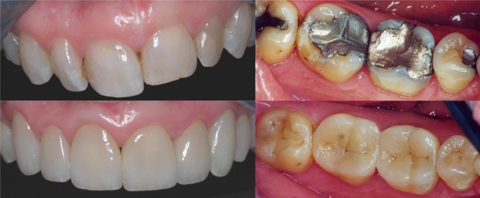 Natural Restorations