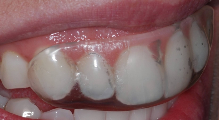 Dental Bite Guard