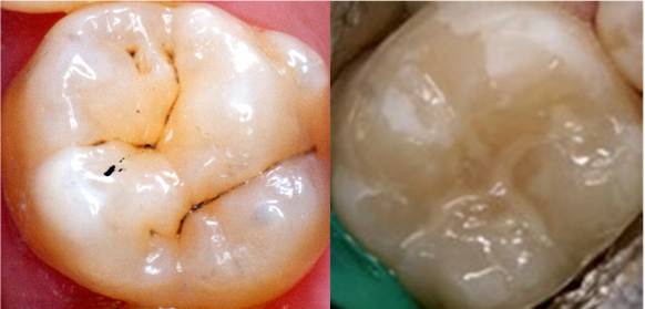 Tooth Fissure Sealant